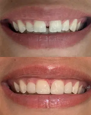 350x360 paisagem — antes e depois caso 2