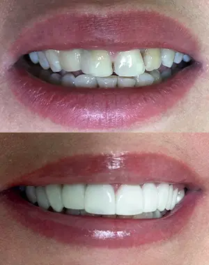 350x360 paisagem — antes e depois caso 1